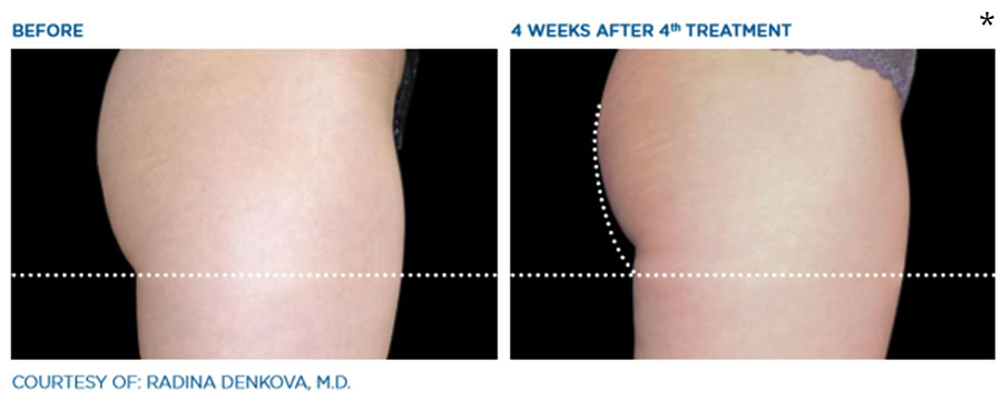 Before and After Photo of Butt Lift Treatment in San Francisco
